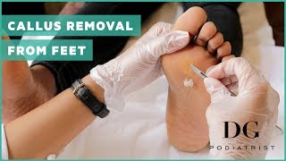 Callus removal from feet balls of feet [upl. by The]