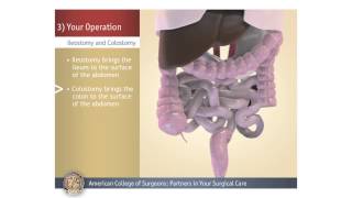 ColostomyIleostomy Your Operation [upl. by Nepets]