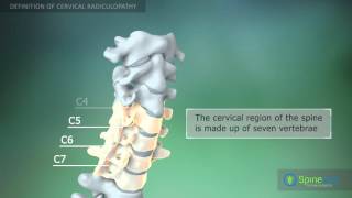 Cervical radiculopathy Definition [upl. by Loree]