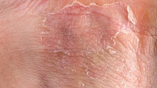 Eczema GRAPHIC Fast Outbreak Treatment Options  Eczema Dermatitis Rash Treatment 2015 [upl. by Jade]