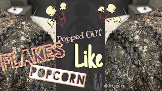 Dandruff Popped Out Like Popcorn [upl. by Iene]