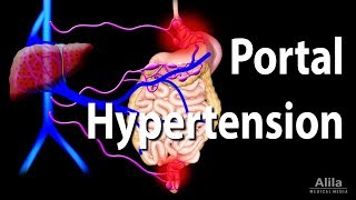 Portal Hypertension Animation [upl. by Quin]