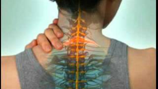 Cervical Radiculopathy  DePuy Videos [upl. by Rancell]