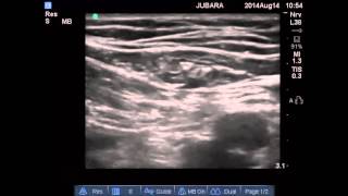 Peroneal Nerve Entrapment  MSR Peroneal Nerve Release [upl. by Curtis]