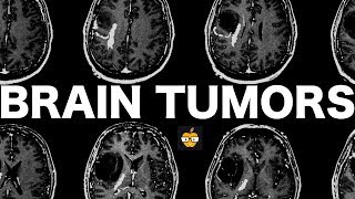 Brain Tumors [upl. by Niltak]