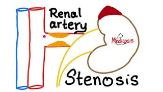 Renal Artery Stenosis [upl. by Nej859]