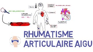 Rhumatisme articulaire aigu RAAde A à Z [upl. by Ztnahc]