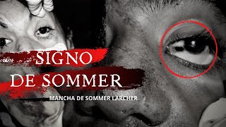 SIGNO DE SOMMER  Fenómenos Cadavéricos Tempranos Oculares  Forenses Investigadores Forenses [upl. by Ispep]