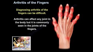 Arthritis Of The Fingers  Everything You Need To Know  Dr Nabil Ebraheim [upl. by Ellissa]