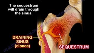 Middle Ear Infection Otitis Media Causes SIgns and Symptoms Diagnosis and Treatment [upl. by Redfield]