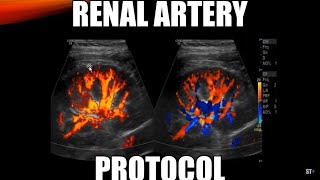 Renal Artery Doppler Protocol  Sonoquickies [upl. by Sumahs]