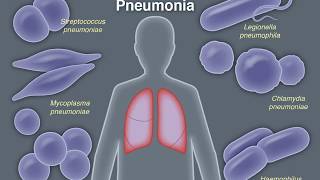 Treating CommunityAcquired Pneumonia [upl. by Ardnaeed493]