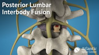 Posterior Lumbar Interbody Fusion PLIF [upl. by Zabrine607]