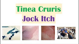 Jock Itch Tinea Cruris  Causes Risk Factors Signs amp Symptoms Diagnosis and Treatment [upl. by Sheley]