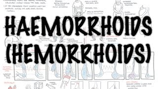 Haemorrhoids Hemorrhoids  Overview pathophysiology investigations and treatment [upl. by Aryaz240]