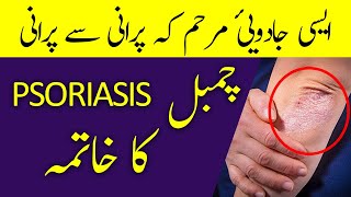 CHAMBAL Ka Ilaj  چمبل  Psoriasis  Signs amp Treatment in URDUHINDI  Hakeem Malik Ahmad Farooq [upl. by Leanatan]