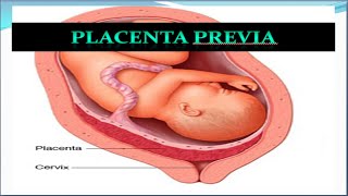 Placenta Previa Update [upl. by Loftus559]