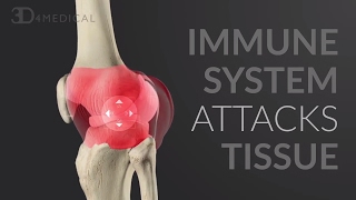 Immunology of the rheumatoid joint [upl. by Nations]