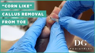 quotCorn likequot callus removal from toe [upl. by Koeninger]