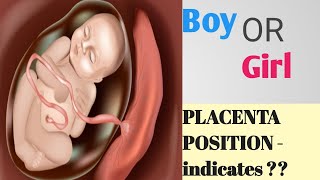 Placenta Positions During Pregnancy  Baby Gender Prediction  Anterior or Posterior Placenta [upl. by Kasey]