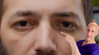 1 Vitamin to Remove Dark Circles  Dr Mandell [upl. by Lefkowitz]