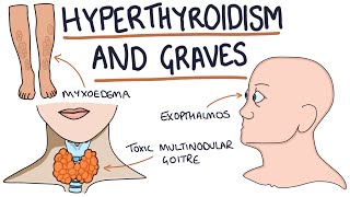 Understanding Hyperthyroidism and Graves Disease [upl. by Ais64]