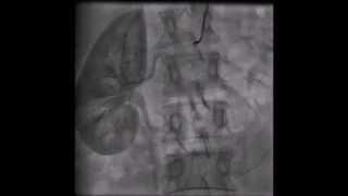 Renal Artery Doppler  Case Study [upl. by Dopp]