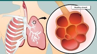 COPD and emphysema [upl. by Bourque]