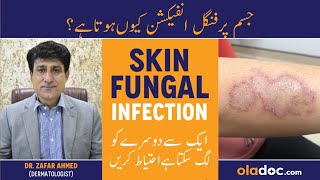 Jism Pe Fungus Ka Ilaj  Skin Fungal Infection Treatment  Ringworm On Skin  Dad Khad Ka Ilaj [upl. by Chafee739]