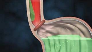 GASTROESOPHAGEAL REFLUX DISEASE  How To DIAGNOSE amp TREAT DYSPHAGIA [upl. by Nnagrom]