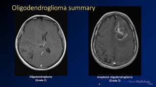 Imaging brain tumors  3  Oligodendrogliomas [upl. by Hester]