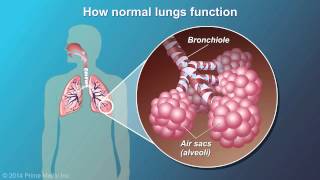 Understanding COPD [upl. by Cowen]