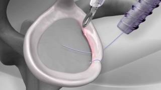 Knotless Shoulder Labral Repair with Arthrex® PushLock® [upl. by Aylmar]