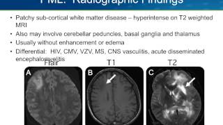 Progressive Multifocal Leukoencephalopathy PML [upl. by Deevan]