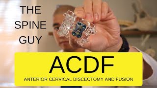 CERVICAL STENOSIS RADICULOPATHY  PART 5  ACDF [upl. by Yesoj]