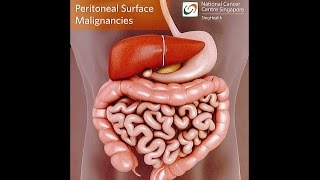 All About Peritoneal Tumours Causes Symptoms Diagnosis and Treatment [upl. by Menken592]