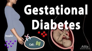 Gestational diabetes  NHS [upl. by Fermin]