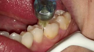 Endodontia de Molar Inferior [upl. by Yenduhc]