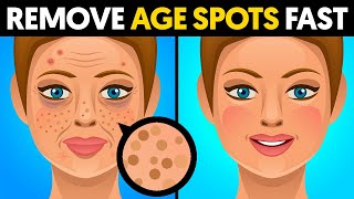 The quickest way to remove age spots [upl. by Reinal111]