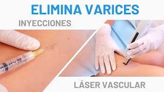 Varices en las Piernas Tratamiento Láser Vascular  Escleroterapia [upl. by Austen]