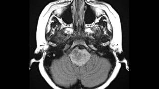 What is glioblastoma [upl. by Yalonda584]