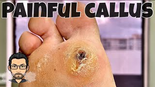 CALLUS REMOVAL FROM FEET [upl. by Ravid]