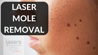 LASER MOLE REMOVAL [upl. by Aiyotal102]