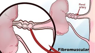 Acute Kidney Injury AKI  USMLE [upl. by Charmion]