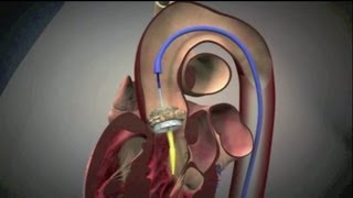 Aortic Stenosis  Murmur Sound amp Animation [upl. by Talmud]