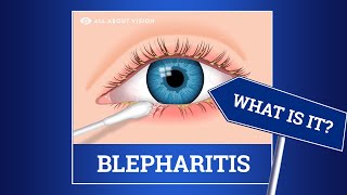 Blepharitis red swollen eyelids Causes Symptoms Treatments [upl. by Reiser]