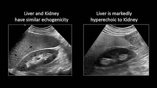 GI Imaging  Hepatic Steatosis and Cirrhosis [upl. by Ita207]