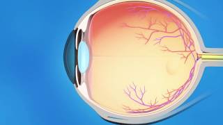 Laser Hemorrhoidoplasty vs Open Hemorrhoidectomy  Hemorrhoid Treatment  Dr Rajasekhar M R [upl. by Aleakcim]