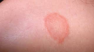 Difference Between Eczema and Ringworm [upl. by Htenek]