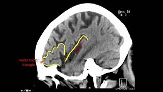 Introduction to Brain Surface Anatomy [upl. by Naginnarb]